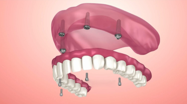 Diagram of implant-supported dentures.