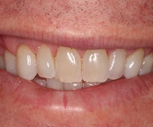 Before & Afters  - The Premier Dental Team