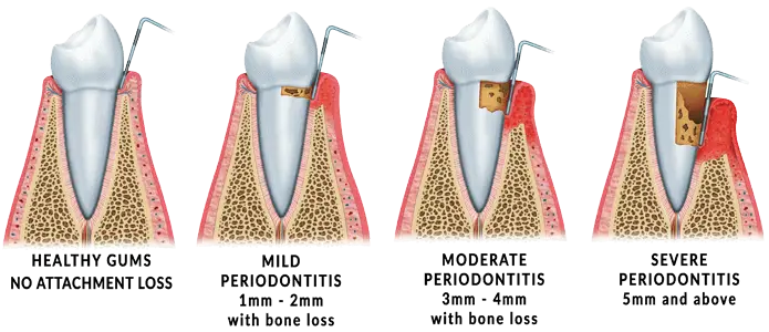 Stages of periodontal disease progression